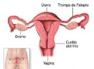 Las mujeres jovenes con cáncer de ovarios podrían conservar la fertilidad