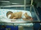 Una prueba para detectar el riesgo de ictericia en recién nacidos