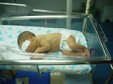 Una prueba para detectar el riesgo de ictericia en recién nacidos