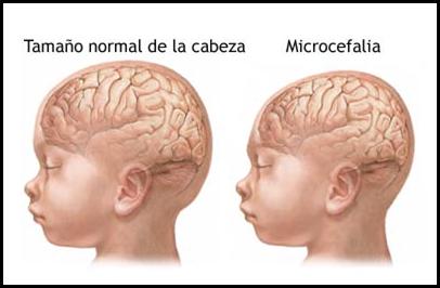 Los recién nacidos con la cabeza muy pequeña deben ser evaluados