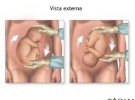 Técnicas para girar al bebé que viene de nalgas