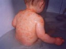 Las humedades y las reformas en casa favorecen la dermatitis en el bebé
