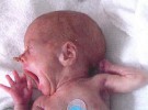 Uno de cada diez recién nacidos en nuestro país es prematuro