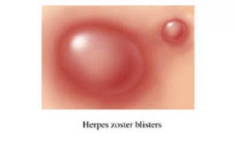 La vacuna contra la varicela protege contra el herpes zóster