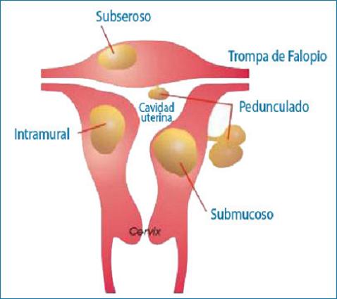 Nace un bebé tras un tratamiento de mioma uterino por ultrasonidos