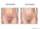 Las grapas causan más complicaciones que la sutura en la cesárea