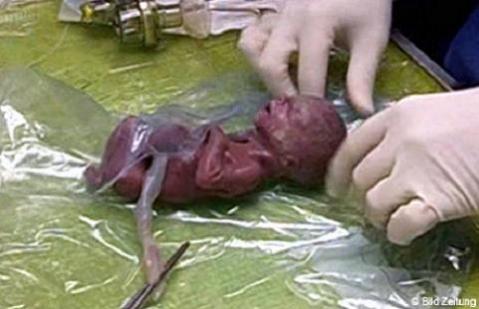 El bebé más prematuro sobrevive con sólo 275 gramos de peso