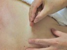 La acupuntura parece no ayudar a reducir el dolor del parto