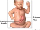 Estenosis hipertrófica de píloro o los vómitos incontrolados del bebé