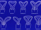 Distintas malformaciones en el útero