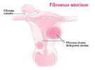 Las víctimas de abuso infantil son más propensas a tener fibromas uterinos