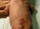 La espina bífida mejor operarla antes del nacimiento