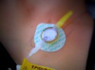 Complicación epidural: Punción accidental duramadre