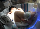 La bilirrubina alta en recién nacidos podría indicar atresia biliar