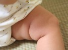 Dolor de cadera en el bebé: Sinovitis transitoria