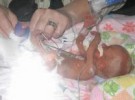 Bebé sobrevive tras pesar al nacer 266 gramos