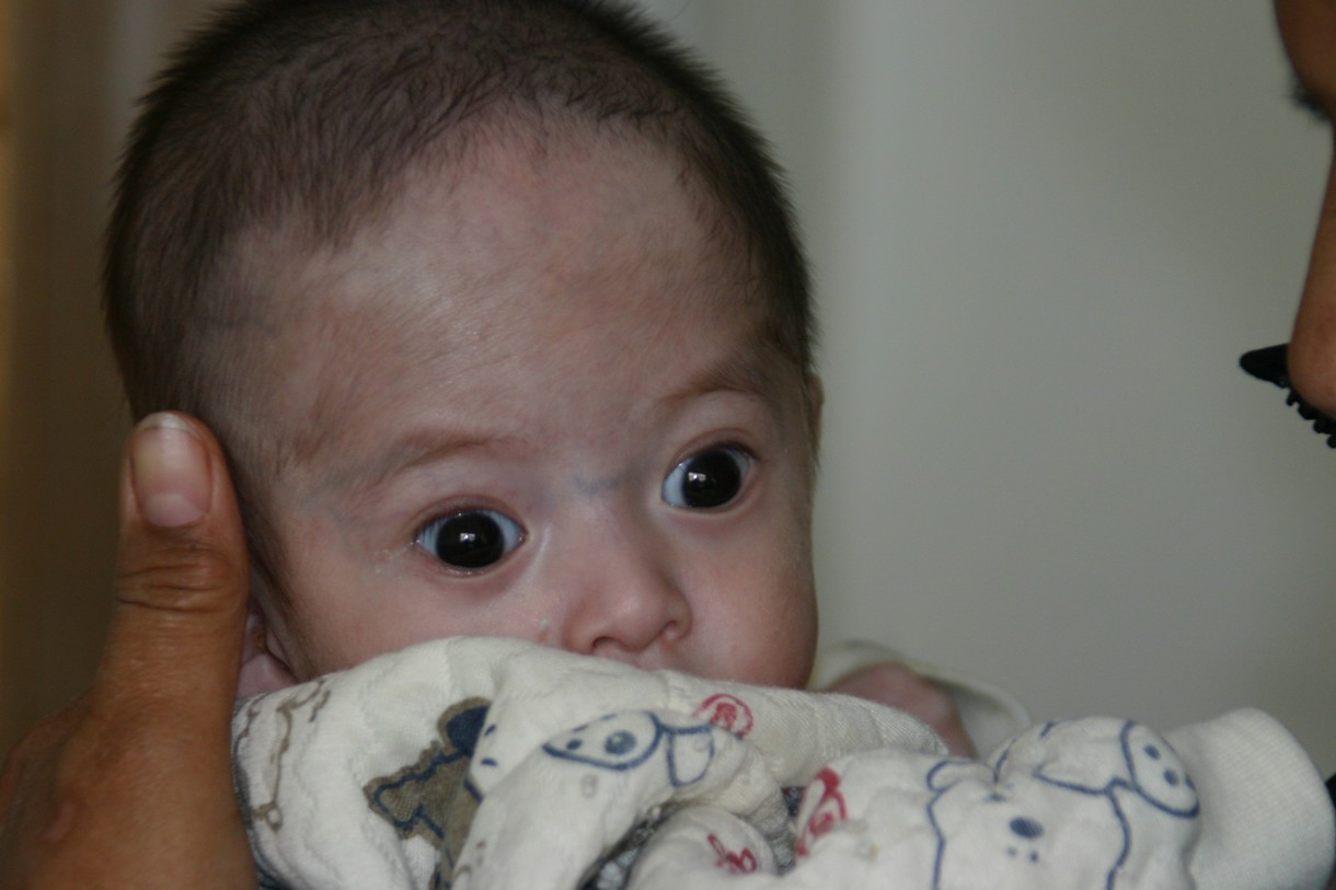 Malformaciones congénitas, alto índice en los bebés chinos