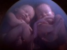 Pelea de gemelos en el vientre materno