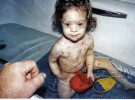 Muere una niña por complicaciones de la varicela