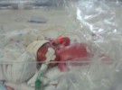 Bolsas de plástico que salvan la vida a bebés prematuros