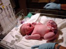 La enfermedad de Hirschsprung o megacolon congénito en el recién nacido