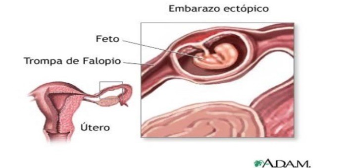 embarazo ectopico